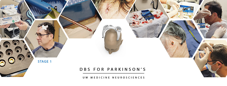 DBS SURGERY – Stage 1